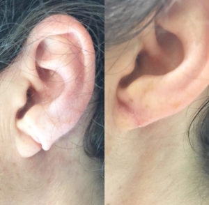ear-lobe-repair