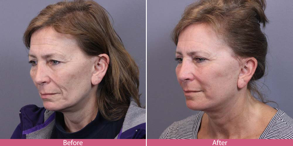 Face Lift Seattle - Face Lift Specialist
